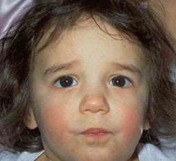 American Association for Pediatric Ophthalmology and Strabismus