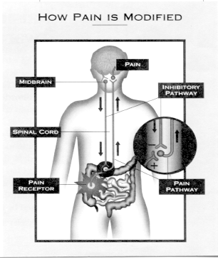 Centrally mediated abdominal pain syndrome (CAPS)