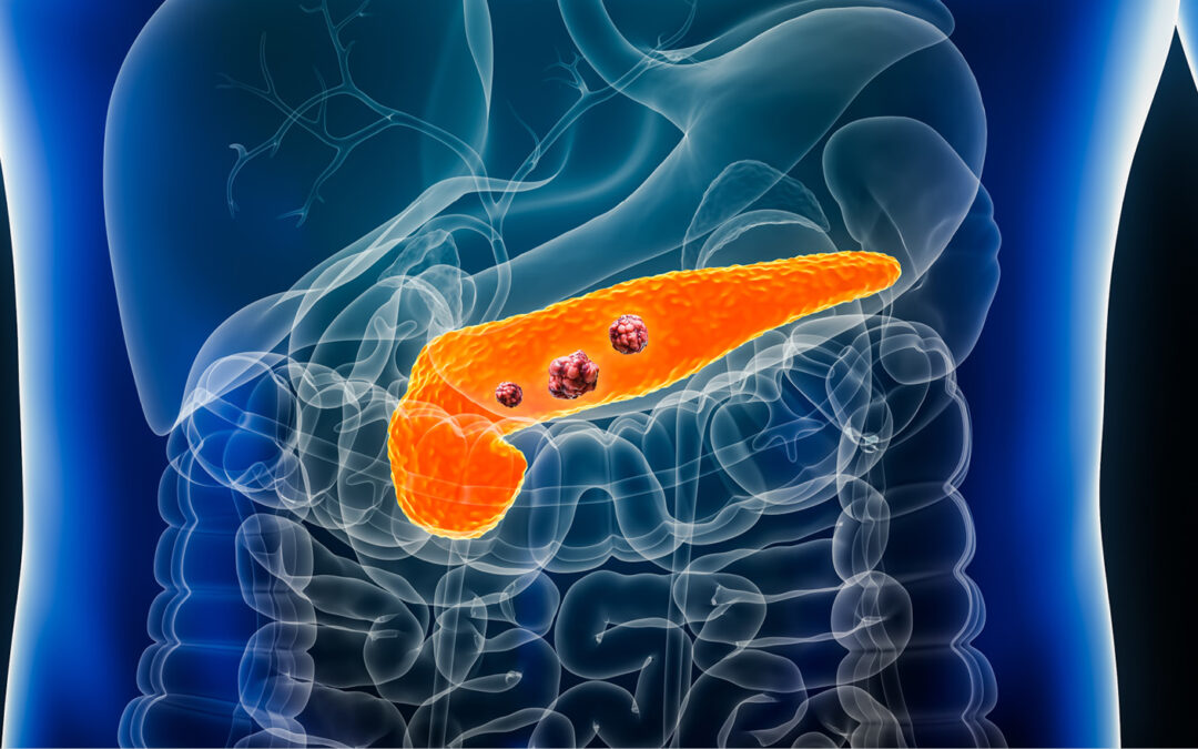 Pancreatic Cancer: What You Need to Know
