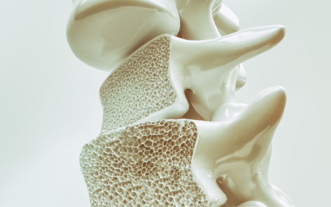 Osteoporosis: What you need to know