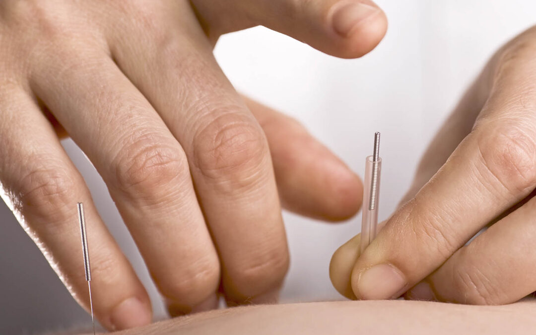 Acupuncture: Effectiveness and Safety | NCCIH