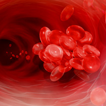 Post-thrombotic Syndrome – Blood Clots