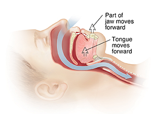 Side view of head with arrow showing the path of air through the nasal passages into the trachea. Arrows show that the jaw has moved forward after the operation.