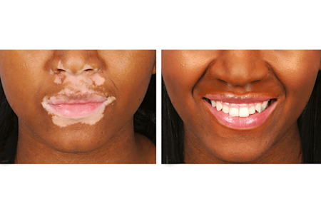 Patient with vitiligo before and after applying camouflage makeup