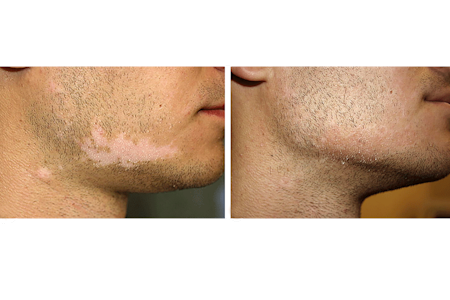 Patient with vitiligo before and after dermatologist performs cell transplant surgery