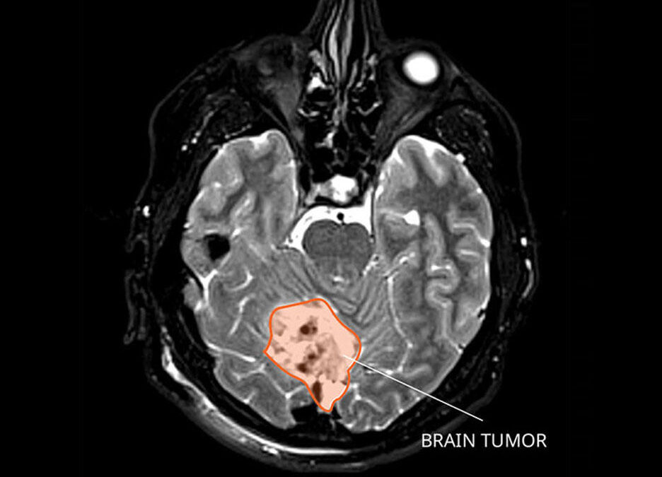 Medulloblastoma: Diagnosis and Treatment – NCI