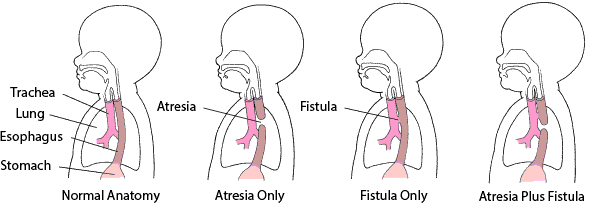 Esophageal atresia and tracheoesophageal fistula – children’s health problems