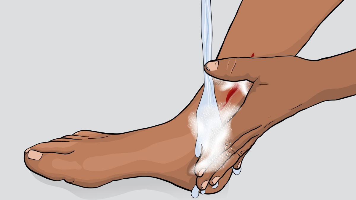 Illustration of a person cleaning an open wound on the leg by washing it with soap and water.