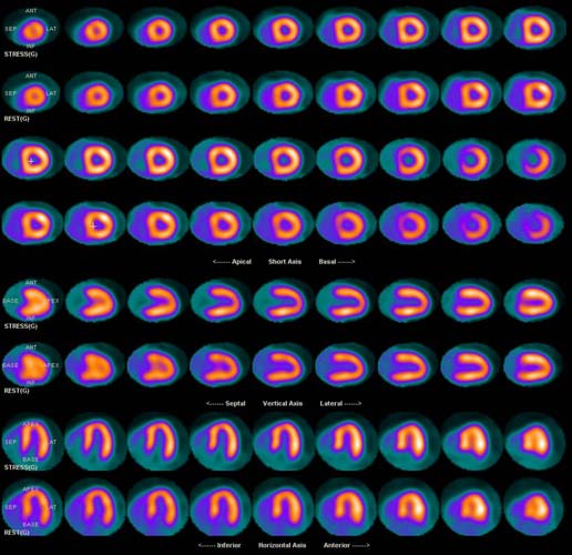 Cardiac (Heart) Nuclear Medicine