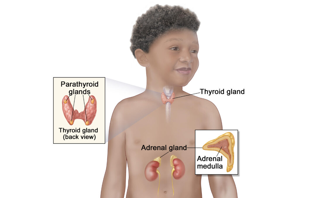 Childhood MEN2 Syndrome – NCI